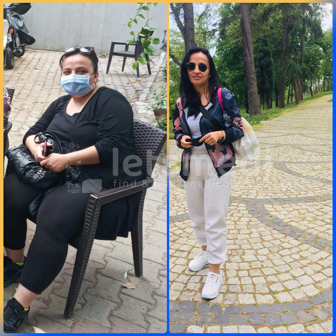 Before and after gastric sleeve in Turkey